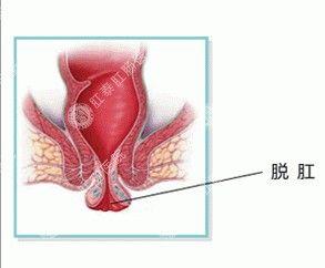嘉定脱肛手术一般多少费用