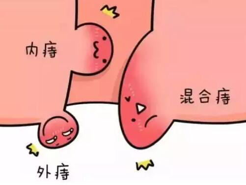 嘉定混合痔手术费用大概多少钱