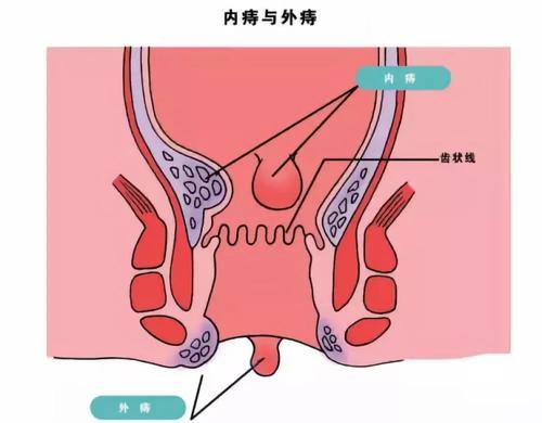 混合痔是怎么引起的 有哪些原因